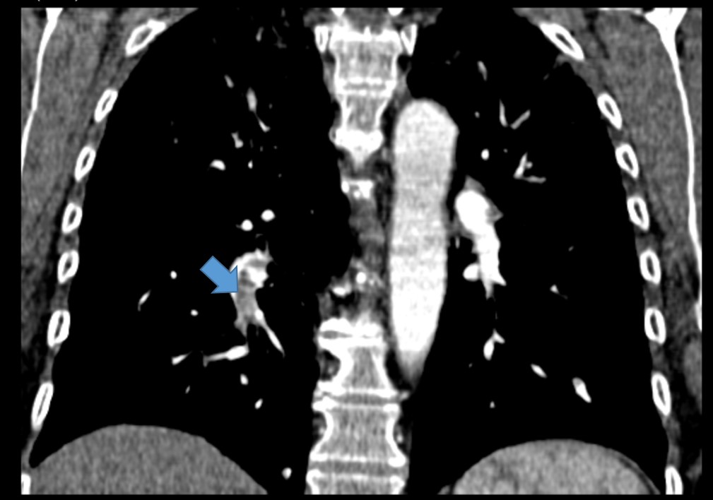 Resultado de imagem para embolia pulmonar