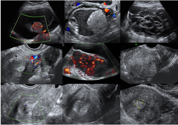 Consensos em ultrassonografia pélvica ginecológica