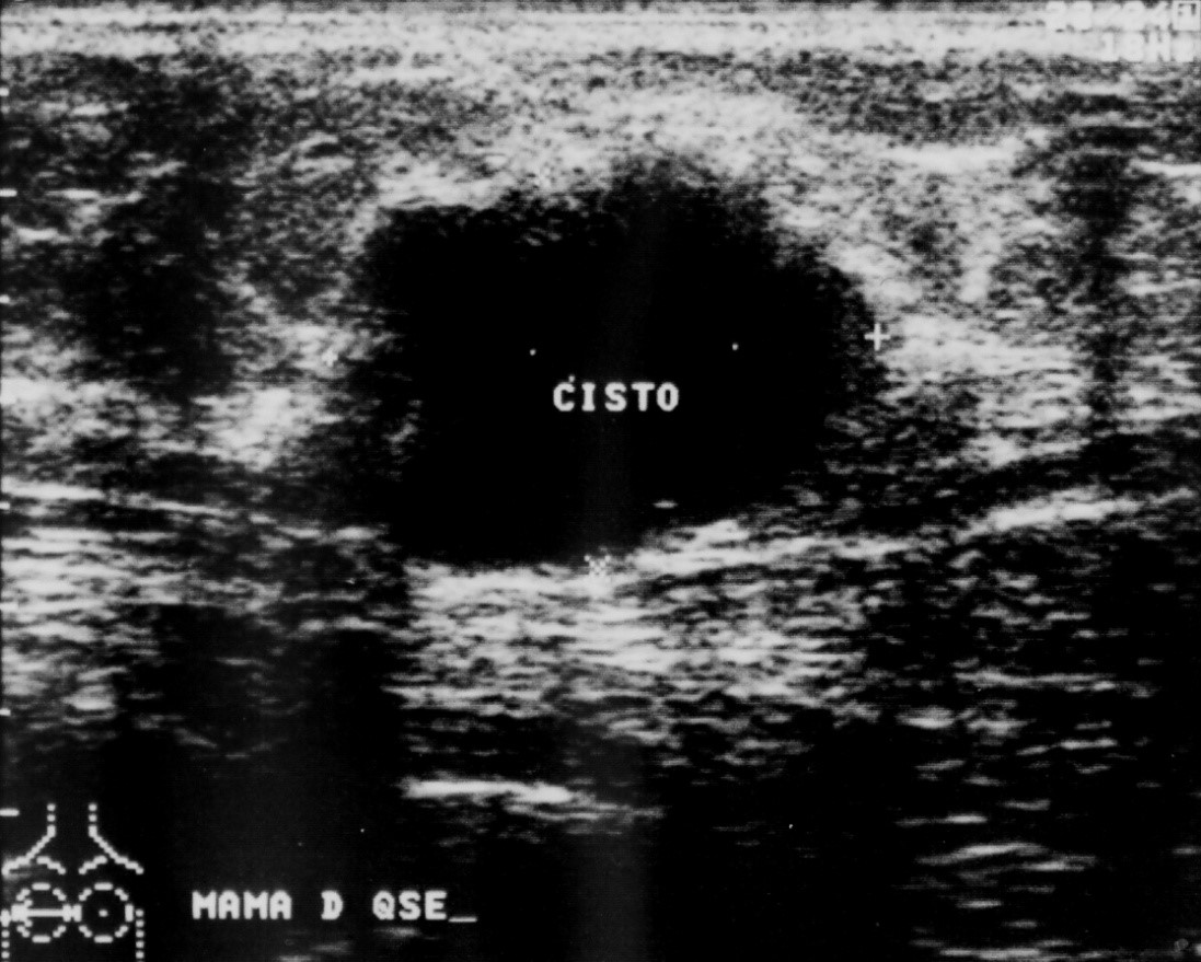 Fonte: Diagnósticos mamográfico e ultrassonográfico falsos negativos: relato de caso. Dr Pixel.